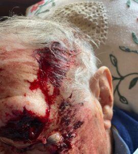 Fotografía clínica de herida traumática en la cabeza de persona mayor con sangrado activo